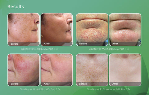 IPL Laser Treatments for Brown Spots or Rosacea